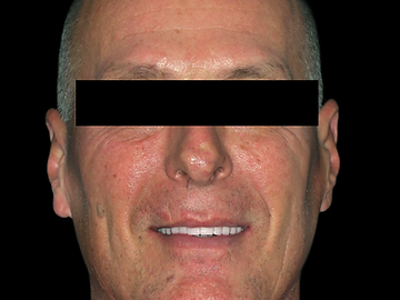 Full-arch implant restoration, after