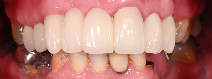 Upper and Lower Zirconia Full Arch, before