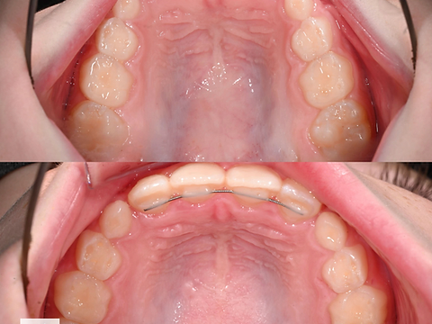 Upper occlusal view before and after arch development
