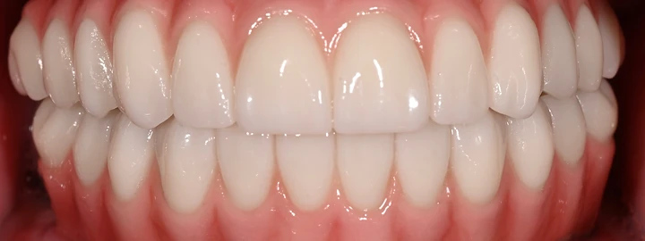 Upper and Lower Zirconia Full Arch, after