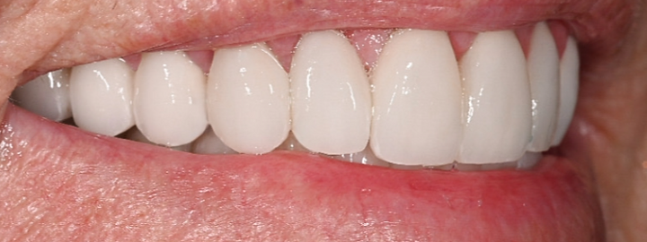 Cosmetic smile transformation, after