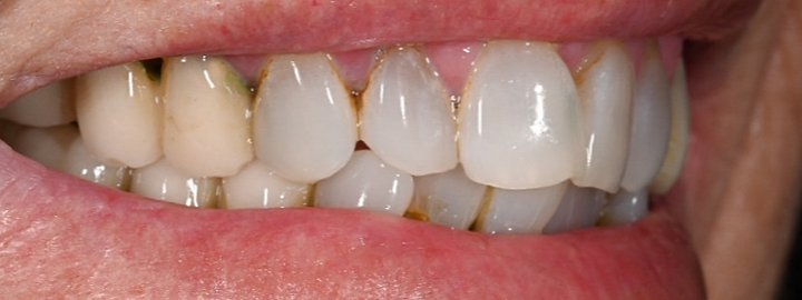 Cosmetic smile transformation, before