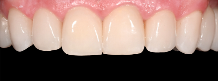 Cosmetic smile transformation, after