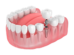 Single dental implant replacing one missing tooth