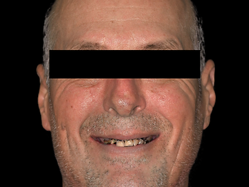 Full-arch implant restoration, before