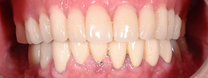 Upper Snap in Denture, Lower PMMA Full Arch, before