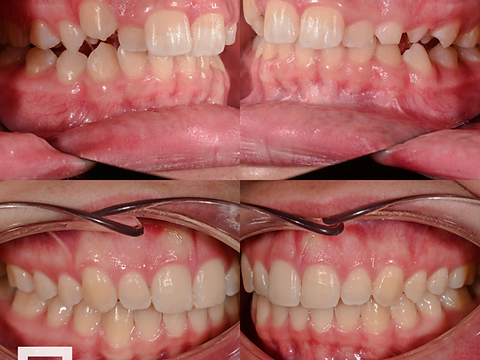 Side-by-side buccal views before and after orthodontic treatment