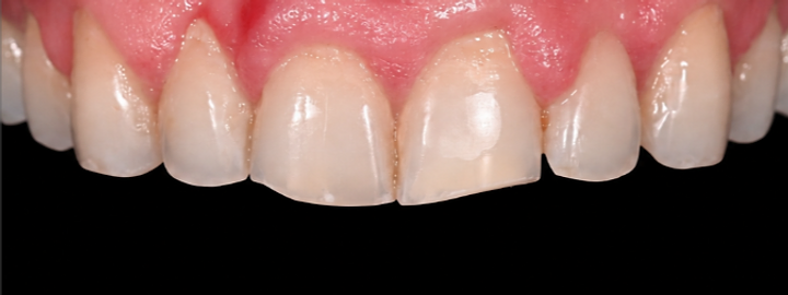 Cosmetic smile transformation, before