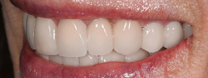Cosmetic smile transformation, after