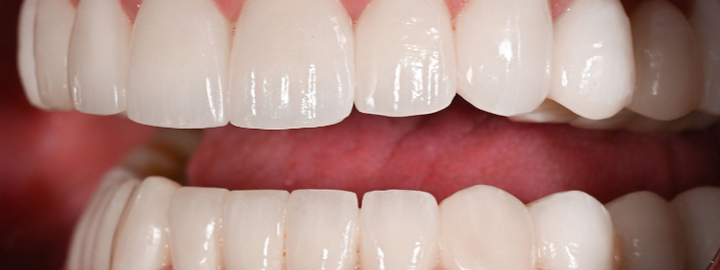 Cosmetic smile transformation, after