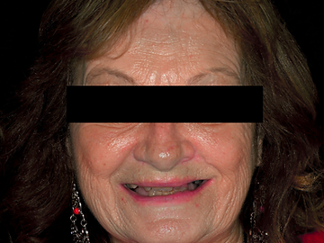 Full-arch implant restoration, before