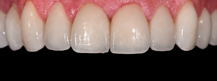Cosmetic smile transformation, after