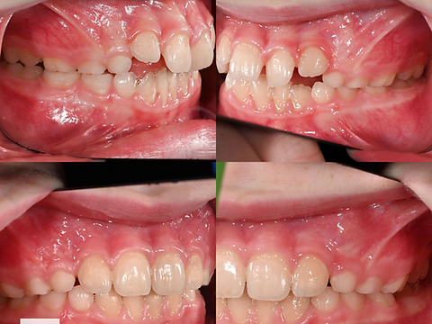 Bilateral buccal views before and after orthodontic treatment