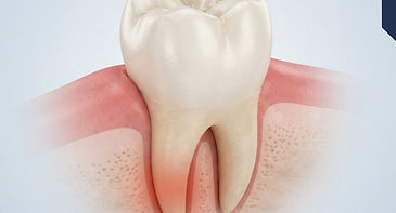 Illustration of a molar with sensitivity near the root