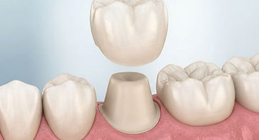 Illustration of a crown lifted above a prepared tooth