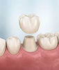 Illustration of a crown lifted above a prepared tooth