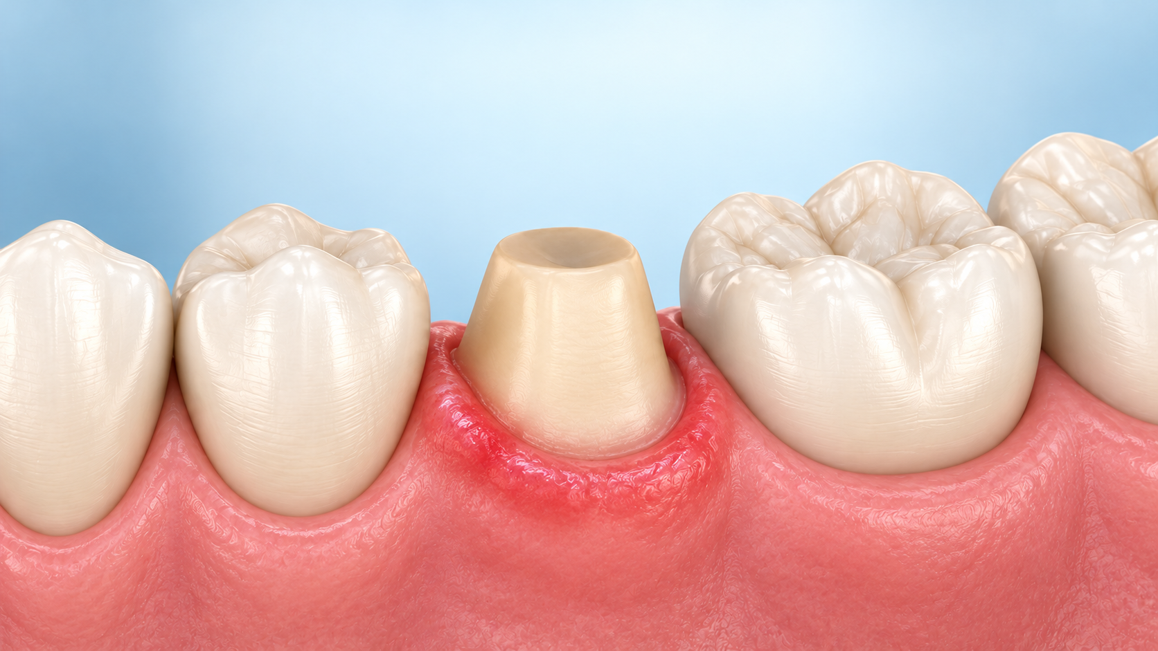 Illustration of a crown lifted above a prepared tooth