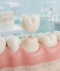 Illustration of a ceramic crown above a prepared tooth