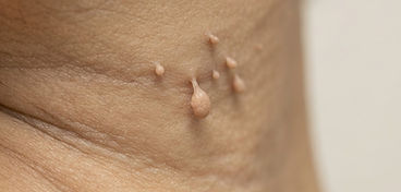 Skin tags