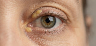 Xanthelasma