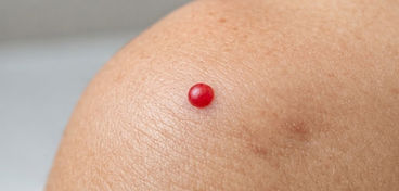Blood spot (Cherry Angioma)