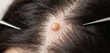 Intradermal Naevus (scalp)