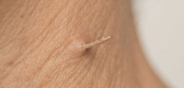 Filiform Wart