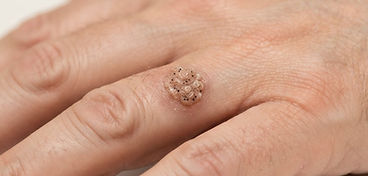 Wart