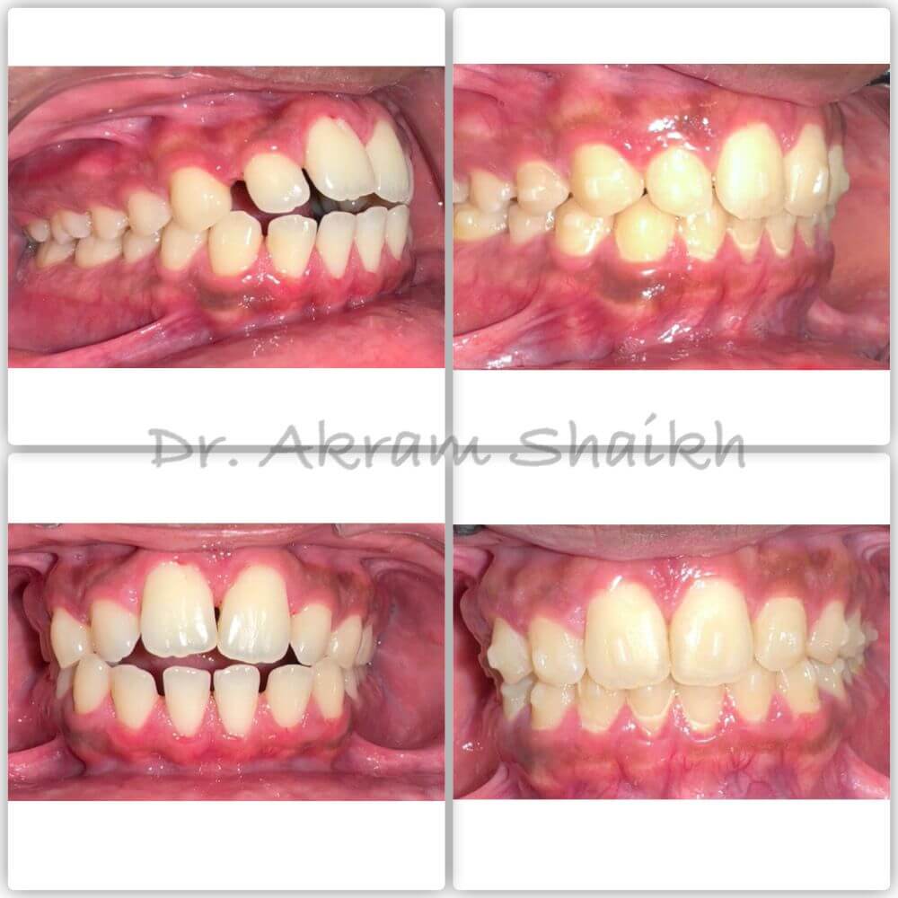 Before and after Orthodontic Alignment — Before & After