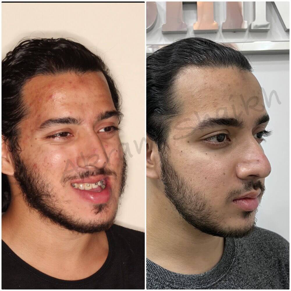 Before and after Braces Transformation — Before & After