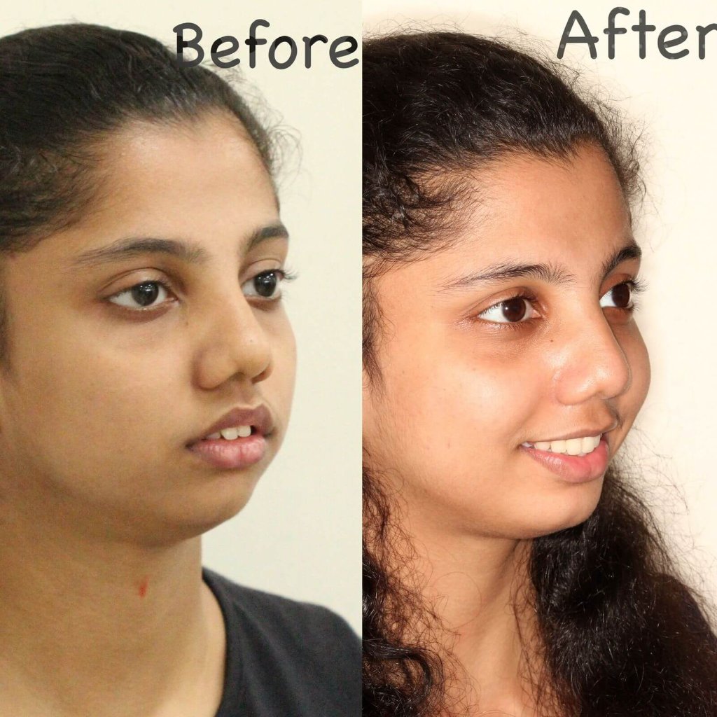 Before and after Profile Correction — Before & After