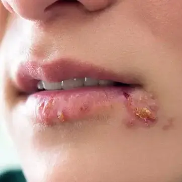 Lázhólyag (herpes simplex)