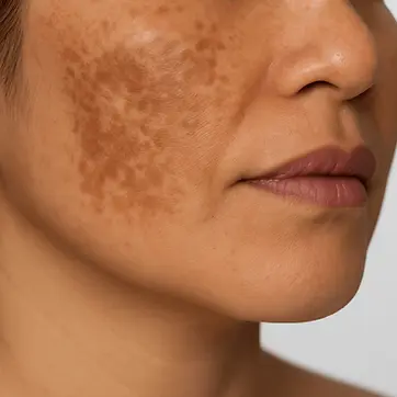 Pigmentfoltok, melasma