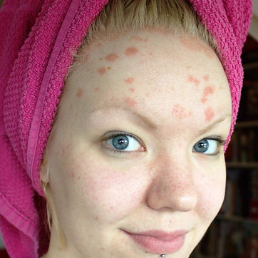 Pikkelysömör (psoriasis)