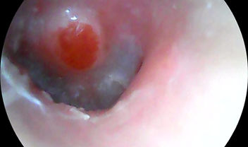Endoscopic view of the ear canal