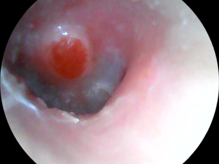 Endoscopic view of the ear canal