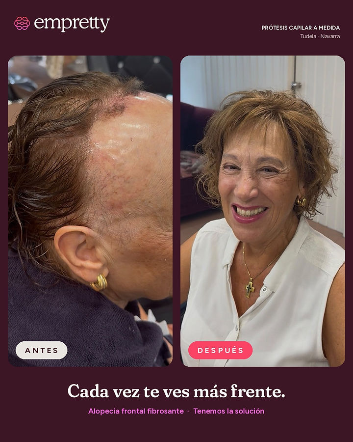 Antes y después de prótesis capilar a medida
