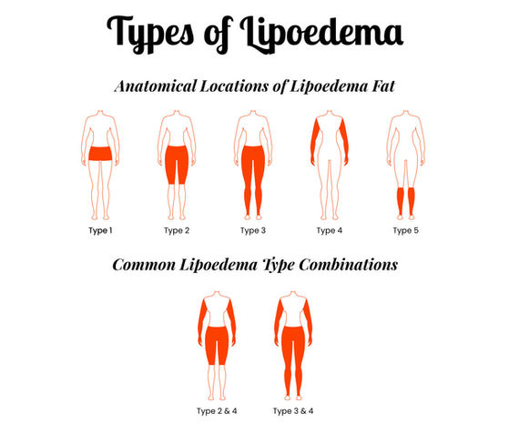 Types of Lipoedema