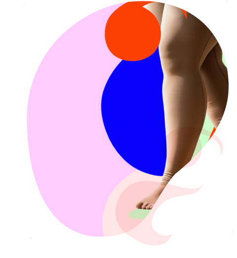 Lipoedema legs in compression stockings