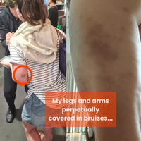 Perpetual Bruising
