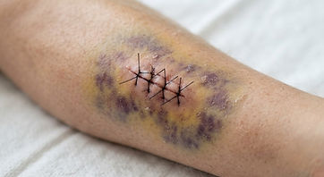A healing leg laceration closed with stitches, surrounded by bruising