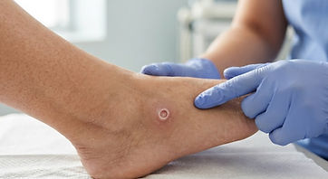 A diabetic foot ulcer on the side of a foot, being examined by a nurse wearing gloves