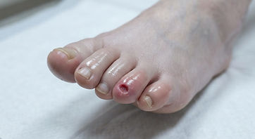 A pale foot with a small deep ulcer at the tip of one toe