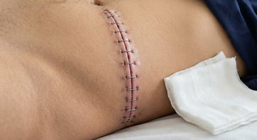 A closed abdominal surgical incision held together with surgical staples