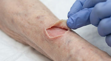 A skin tear on the fragile forearm skin of an older adult, with the skin flap held gently in place
