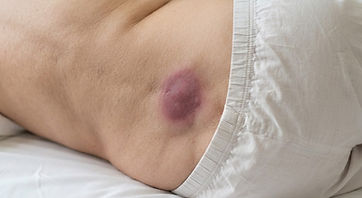 An early pressure sore on the skin over the tailbone of an older adult lying on their side
