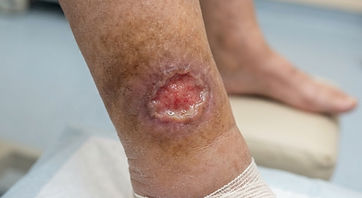 A shallow venous leg ulcer above the ankle, surrounded by swollen and stained skin