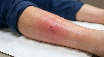 Red, swollen cellulitis spreading across a lower leg around a break in the skin
