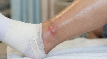 A swollen lower leg and ankle with stretched skin and a compression bandage