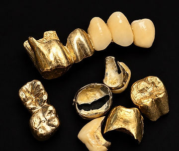 Zahngold: Goldkronen und eine Brücke, teils mit Keramik